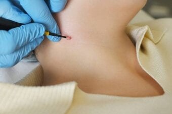 Should You Consider Surgery Skin Tag Removal?